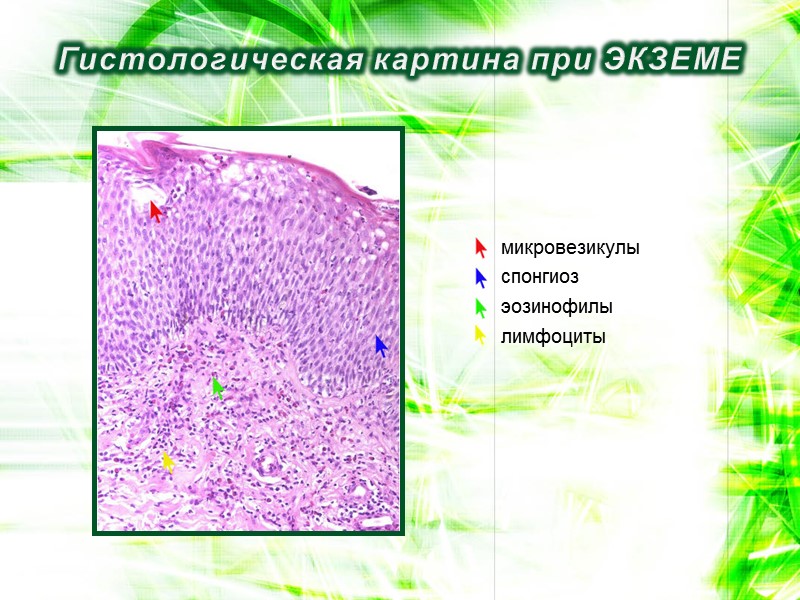 Гистологическая картина при ЭКЗЕМЕ микровезикулы спонгиоз эозинофилы лимфоциты